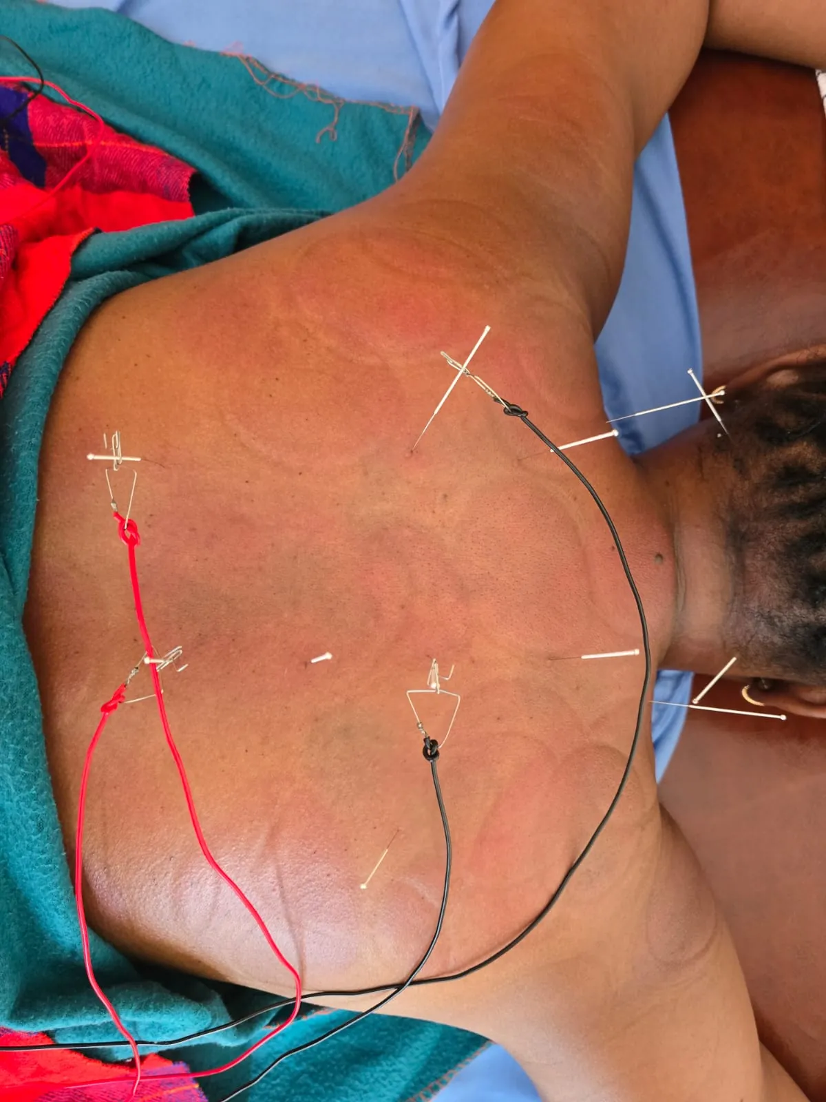 Electro-acupuncture treatment targeting the shoulder and upper back